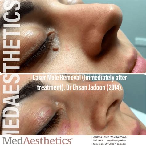 Laser Mole Removal Perth Medaesthetics