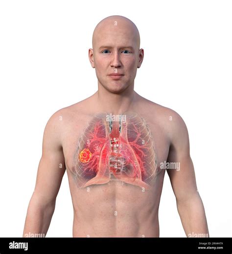 Lung Mucormycosis Lesion Illustration Stock Photo Alamy