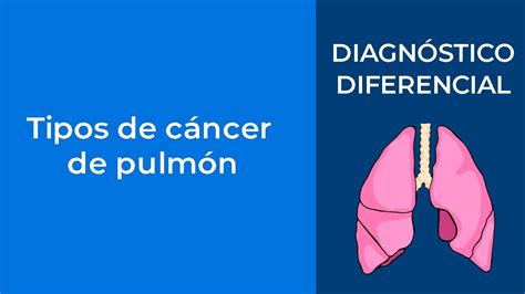 Diagnóstico Diferencial Tipos de cáncer de pulmón YouTube