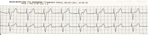 Float Nurse: EKG Rhythm Strips 22: Paced Rhythms