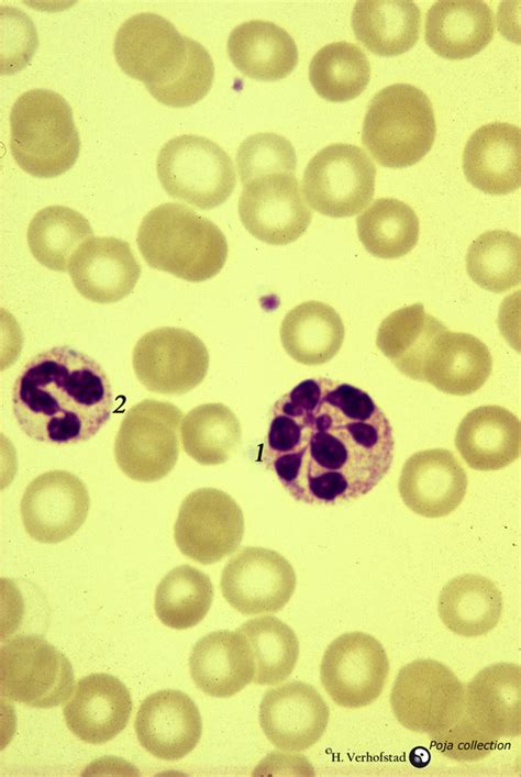 Hypersegmented Neutrophils