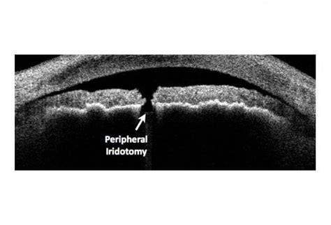 Laser Peripheral Iridotomy Wills Eye Hospital