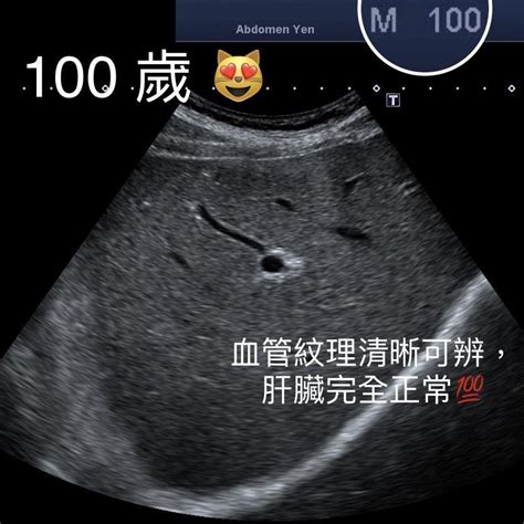 100歲肝臟超健康！醫見超音波照讚嘆：清晰細緻 人瑞3生活習慣曝光 Ettoday健康雲 Ettoday新聞雲