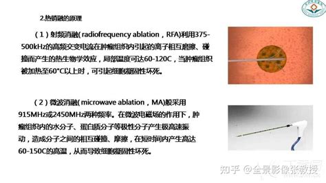 肺结节的评估手段及全程管理 知乎