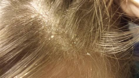 Help My Dandruff Is Insanely Bad And I Dont Want To Use Shampoo If I