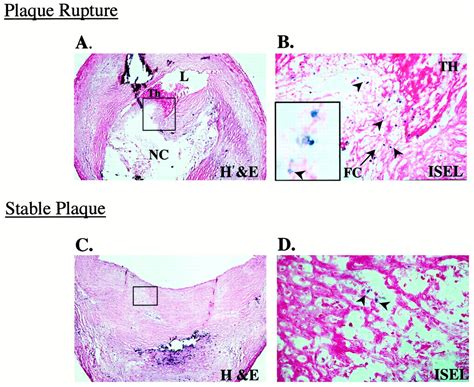 Localization Of Apoptotic Macrophages At The Site Of Plaque Rupture In