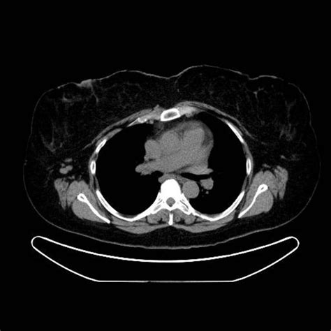 Another slice of the CT scan showing right axillary adenopathy ...