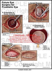 Future Eye Surgery for Prosthetic Eye Medical Exhibit Medivisuals