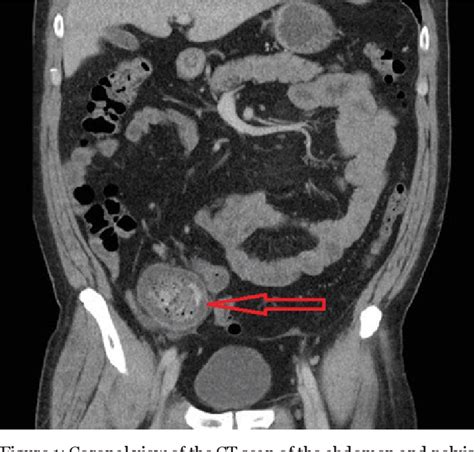 Figure From Axial Torsion Of A Giant Meckels Diverticulum Semantic