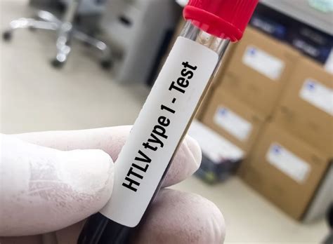 Expertos analizan la pandemia silenciosa del virus HTLV-1