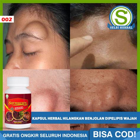 Kapsul Sarang Semut Sarmucare Kapsul Herbal Menghilangkan Benjolan Di