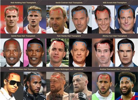 Celebrities With Hair Transplants 104 Before And After Photos