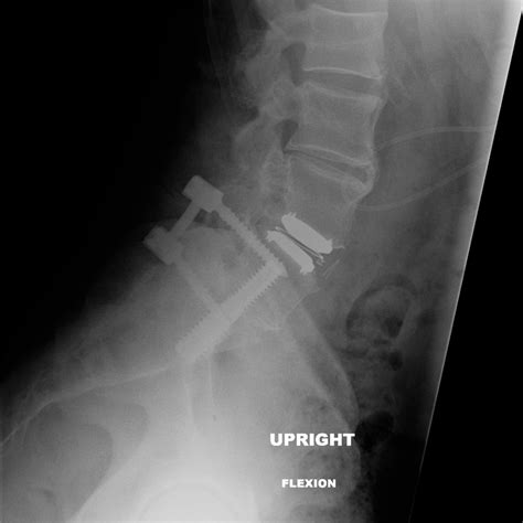 The implanted AxiaLiF device. Lateral radiographic view of L5/S1 fusion ...