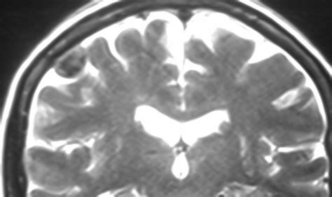 Daily Dose: Calcified meningioma