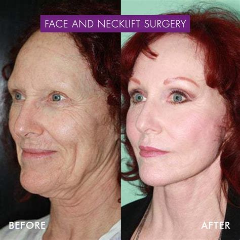 Facial Swelling Face Lift Telegraph