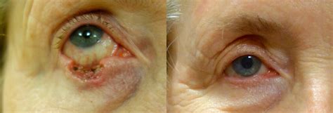 Eyelid Skin Cancer (MOHS) Reconstruction Before and After Photos