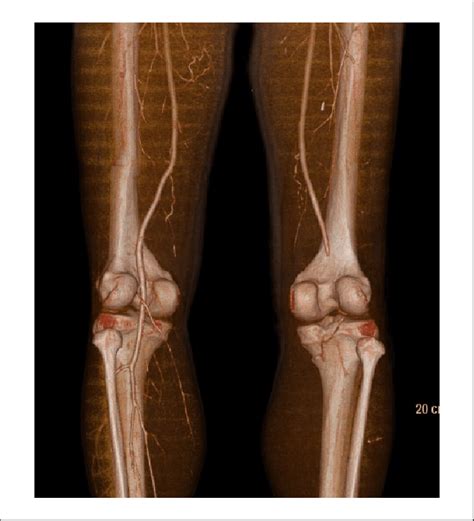 In Preoperative Ct Angiography Right Popliteal Artery Occlusion Was