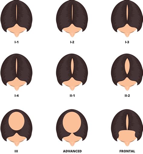 Female Pattern Baldness International Hair Studio