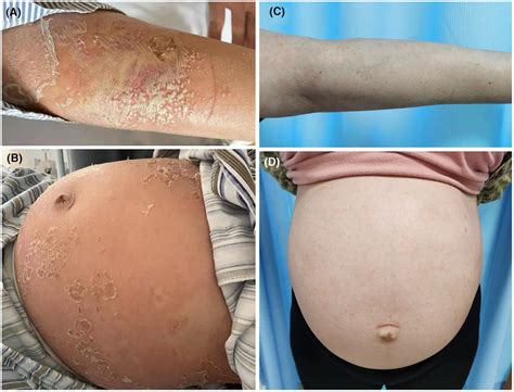 Generalized Pustular Psoriasis Gpp Of Pregnancy Before And After