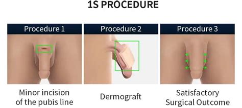 5S Penis Enlargement Surgery Proud Urology Clinic