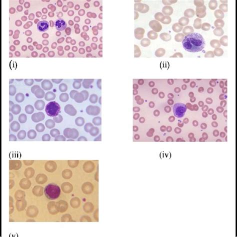 I Image Showing Nucleated Cells Nrbc Circled In Red And Wbc Circled