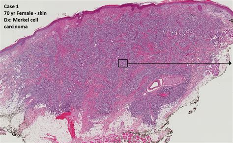 Merkel Cell Carcinoma Histology