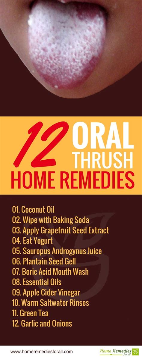 Use these effective home remedies to get rid of oral thrush fast ...