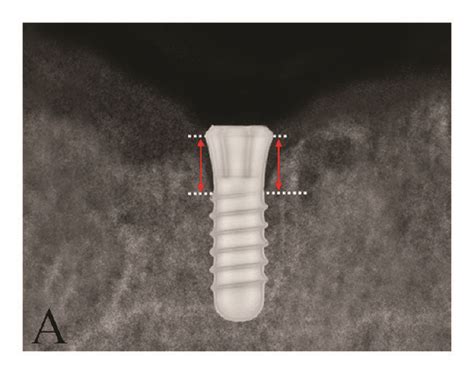 A Schematic Of Iti Straumann Dental Implant Measurement Was Taken