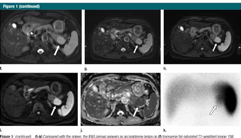 Figure 1 From Differentiation Of An Intrapancreatic Accessory Spleen