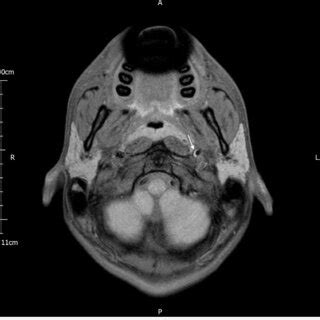 Ct Scan Showing A Subperiosteal Abscess White Arrow Along The Left