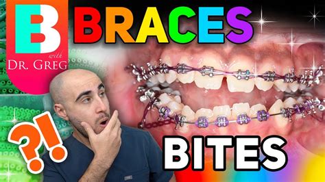 Braces Overbite Overjet Underbite Crossbite And Open Bite Explained