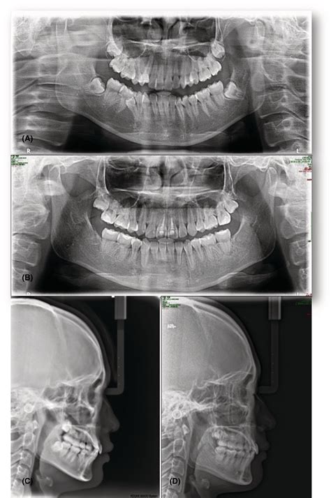 Pretreatment And Posttreatment Radiographs A Pretreatment Panoramic