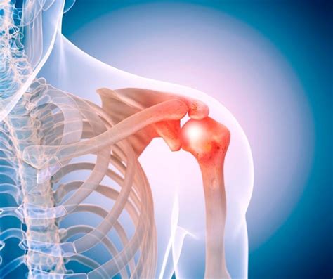 Tratamiento De Tendinitis De Hombro Con Ozonoterapia M Dica Tarragona