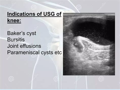 Radiological Anatomy Of Knee Joint Pptx