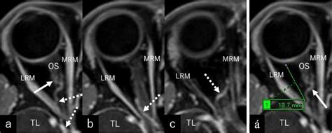 Serial Post Contrast Axial T1 Weighted Magnetic Resonance Images A C