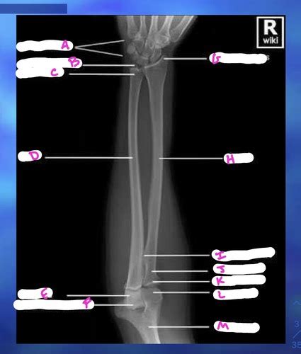 Sherman X Ray Analysis Upper Extremity Flashcards Quizlet