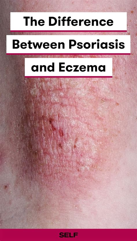 How to Tell the Difference Between Psoriasis and Eczema | Skin conditions psoriasis, Psoriasis ...