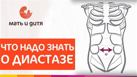 ☝ Диастаз прямых мышц живота признаки и методы лечения. Диастаз прямых ...