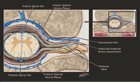 Pdf Intradural Spinal Vein Enlargement In Craniospinal Hypotension