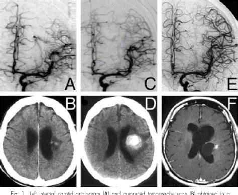 Figure 1 From Analysis Of Complications Based On Long Term Outcomes After Radiosurgery For