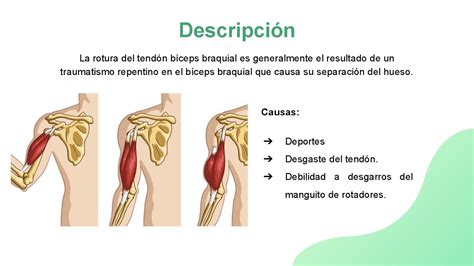 Rotura De B Ceps Del Tend N De B Ceps Braquial Diapositivas De