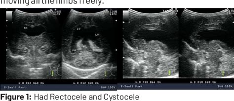 Figure 1 From Sonographic Prenatal Screening In Diagnosis Of Neural Tube Defects During 1st And