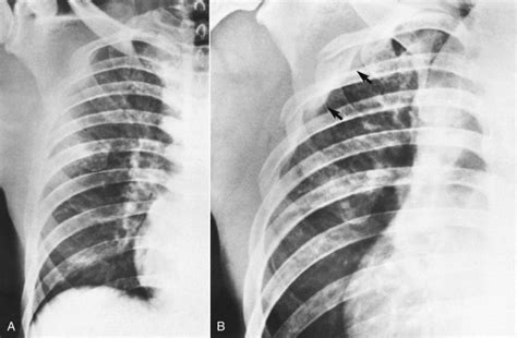 Rib Fractures | Anesthesia Key