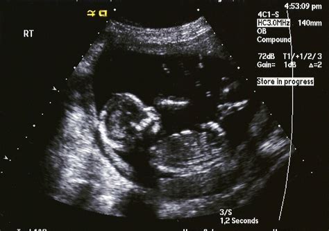 Smithback Twins: 16 Week Ultrasound Pictures!