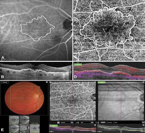 Optical Coherence Tomography And Oct Angiography Characteris Retina