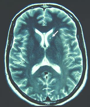 Figure T2 Weighted Axial Brain Magnetic Resonance Images Note The