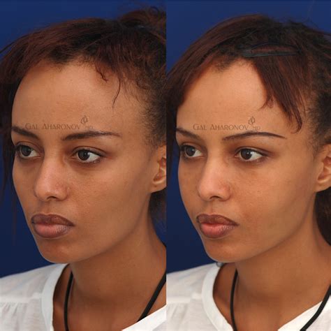 Temple And Forehead Filler Plastic Surgery