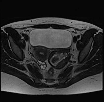 Ruptured Ovarian Hemorrhagic Cyst Radiology Case Radiopaedia Org