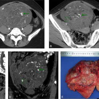 Grade 3 Immature Teratoma Of The Right Ovary In A 12 Year Old Girl And