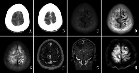 Cerebral Syphilitic Gumma Masquerading As Cerebral Metastatic Tumors